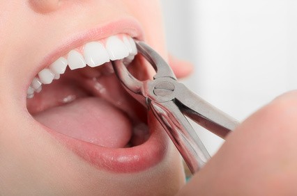 علل کشیدن دندان در ارتودنسی
