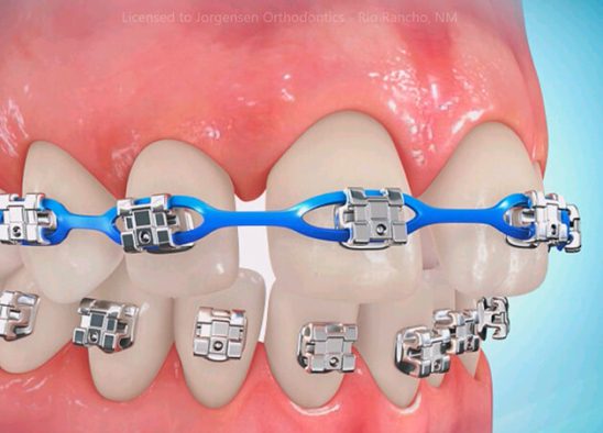 فضای بین دندان ها و درمان ارتودنسی