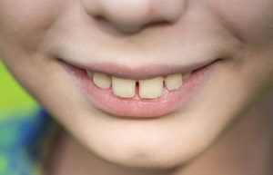علایم فضای بین دندان ها