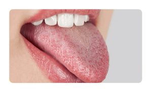 Dry mouth and problems in the salivary glands
