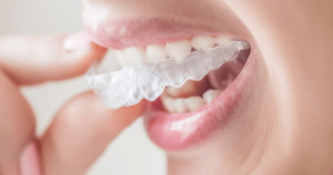 Fixing teeth after teeth movement in orthodontics