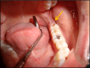Hidden teeth