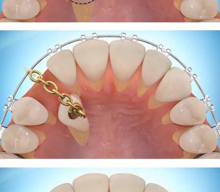 Hidden teeth and their orthodontic treatments