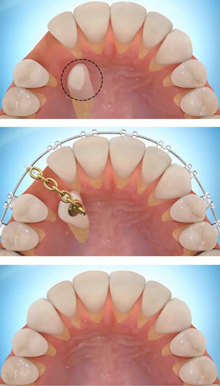 Hidden teeth and their orthodontic treatments