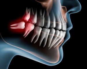 Hidden wisdom teeth