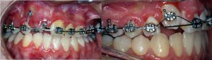 hidden Inclined teeth