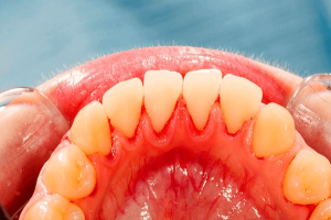 Infection of gums and third tonsils