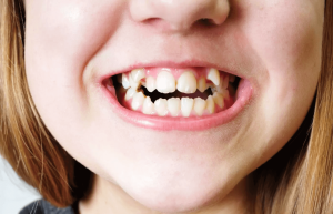 Lack of space in orthodontic treatment despite the problem of the third tonsil