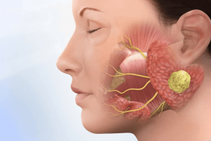 Obstruction of salivary glands