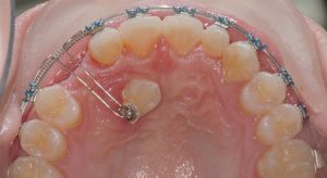 Other hidden impacted teeth
