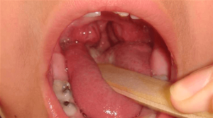 Pressure of the teeth due to the problem of the third tonsil