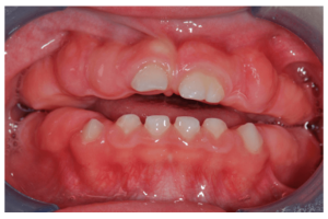 Problems with the development of milk teeth