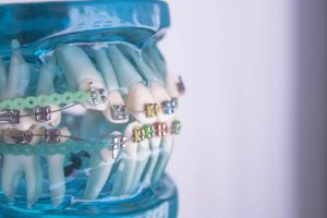 Teeth movement in orthodontics