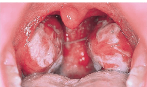 The effect of the third tonsil in orthodontic treatment