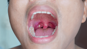 The effect of the third tonsil on restoration and orthodontics