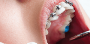 The mechanism of teeth movement in orthodontics