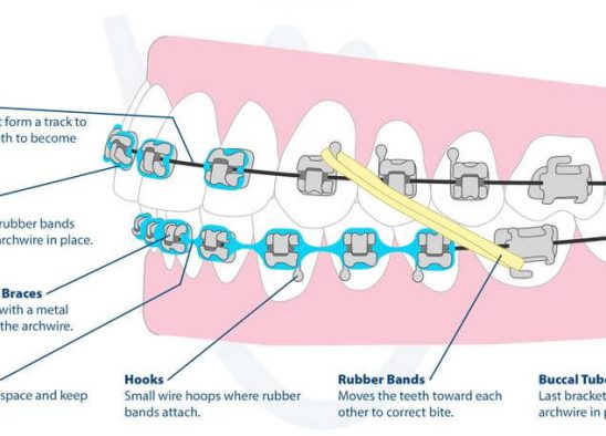 The mechanism of teeth movement in orthodontics & parts of Braces Diagram