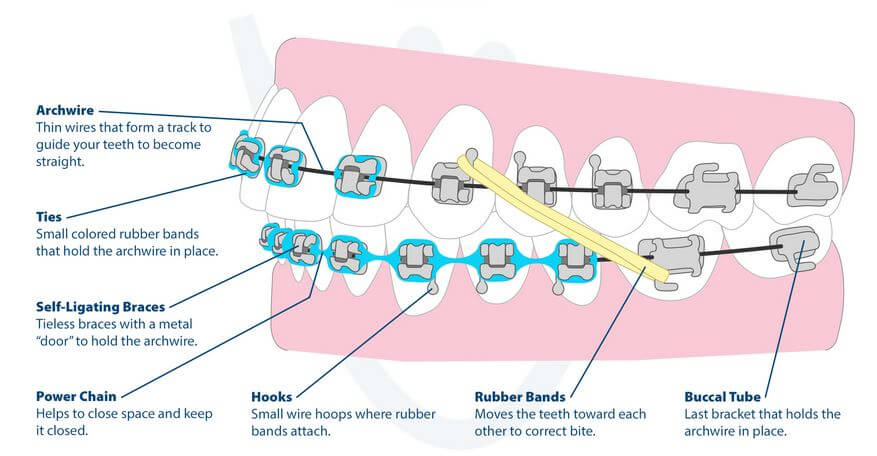 The mechanism of teeth movement in orthodontics & parts of Braces Diagram
