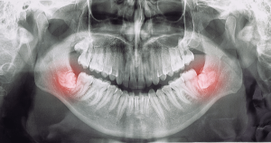 The reason for the growth of latent teeth