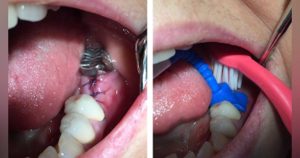 Treatment of hidden impacted teeth