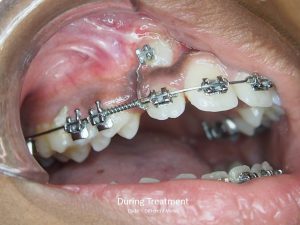 Treatment of hidden impacted teeth with orthodontics