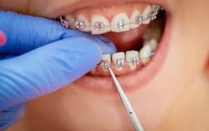 Treatment of milk teeth with orthodontics