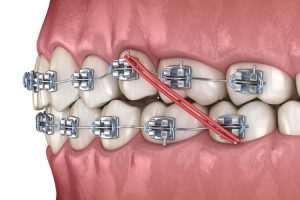 Using braces to move teeth in orthodontics