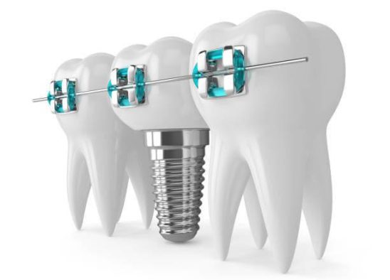 درمان ترکیبی ارتودنسی و پروتز دندانی