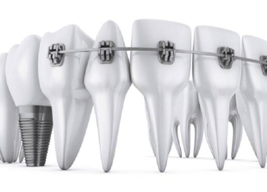 درمان ترکیبی ترمیم دندان با ارتودنسی و پروتز دندانی