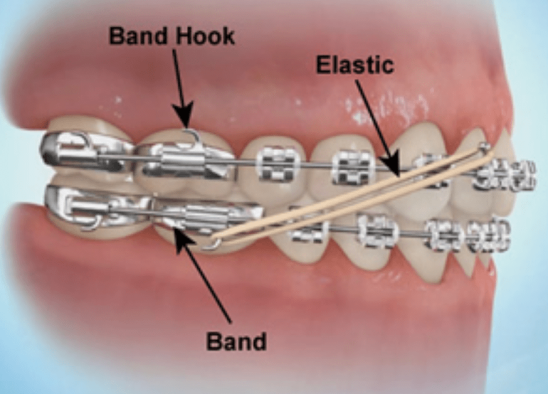 الاستیک‌های بین فکی تنظیم فشار دندان ها با الاستیک‌های بین فکی تنظیم بایت با الاستیک‌های بین فکی مدت زمان استفاده از الاستیک‌های بین فکی عوارض استفاده از الاستیک‌های بین فکی درد و ناراحتی استفاده از الاستیک‌های بین فکی عملکرد الاستیک‌های بین فکی