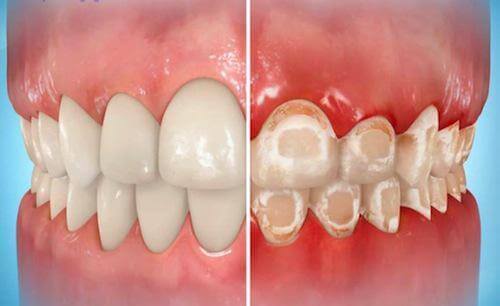 لکه‌های سفید در دندان‌ها و رابطه آن‌ها با ارتودنسی
