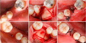 پیوند استخوان دندان به روش اتوژن