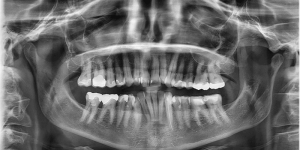 تشخیص موقعیت دندان ها با رادیوگرافی CBCT