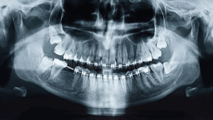 تشخیص موقعیت دندان ها با رادیوگرافی CBCT