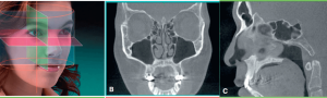 تشخیص بیماری های عصبی با رادیوگرافی CBCT