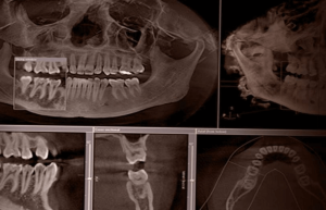 بررسی بنیادی های دندان با رادیوگرافی CBCT