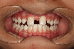 افرادی که باید پیوند استخوان دندان انجام دهند