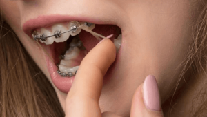 باندها از نظر جنس مواد و وسایل ارتودنسی