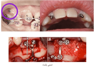 تشخیص استفاده از مینی پلیت ها