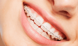 براکت های سفید از نظر متریال و وسایل ارتودنسی