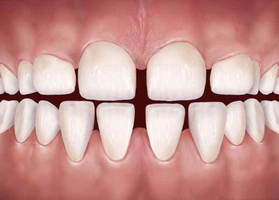 مشکلات فاصله بین دندان ها در ارتودنسی - فاصله زیاد