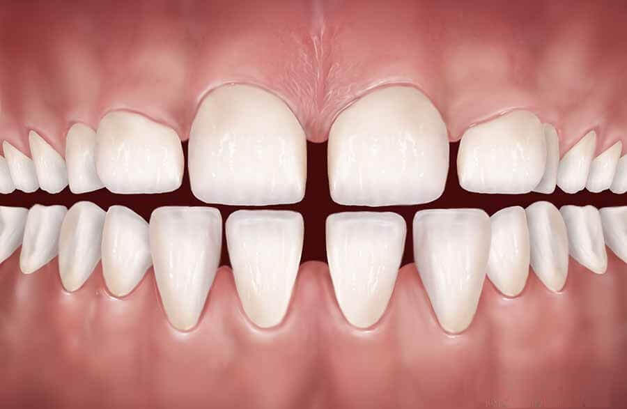 مشکلات فاصله بین دندان ها در ارتودنسی - فاصله زیاد