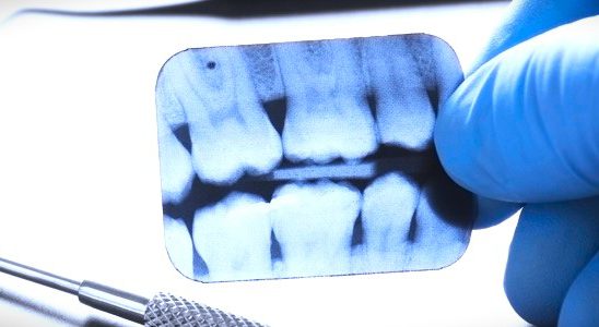 رادیوگرافی های تک دندانی چه کاربردی دارند