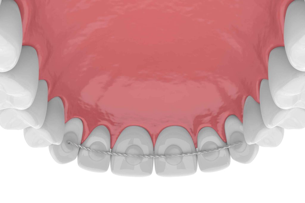 مزایای نگهدارنده های ثابت