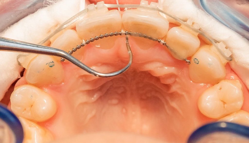 نگهدارنده های ثابت و مراقبت آن‌ها