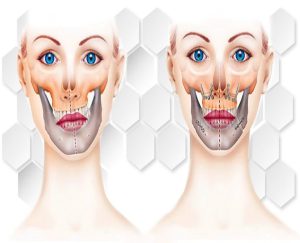 کندیل فک پایین