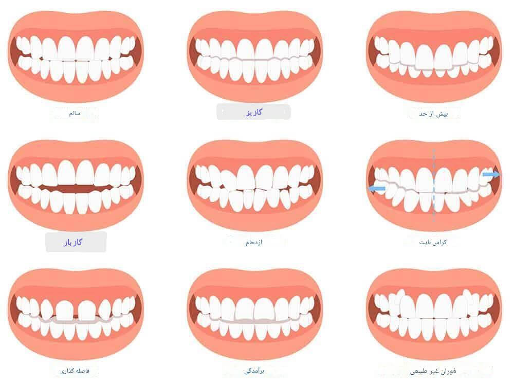 ناهماهنگی‌های دندانی