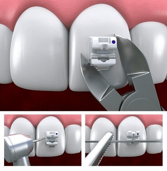 دی باندینگ ارتودنسی