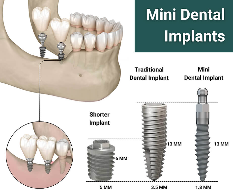 مینی اسکروها، مینی ایمپلنت ها، میكرو ایمپلنت ها