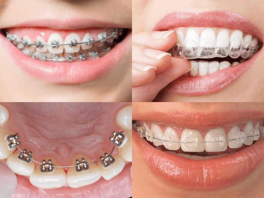 آینده ارتودنسی